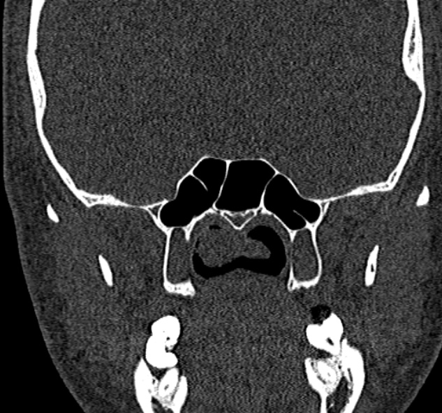 Antrochoanal polyp (Radiopaedia 30002-30554 Coronal bone window 63).jpg