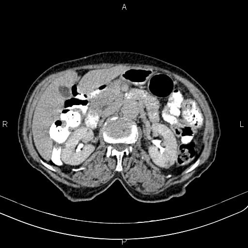 File:Aortic aneurysm and Lemmel syndrome (Radiopaedia 86499-102554 Axial C+ delayed 31).jpg