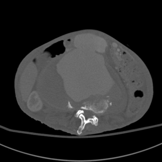Aortic aneurysm with spinal destruction (Radiopaedia 42301-45410 Axial bone window 48).jpg