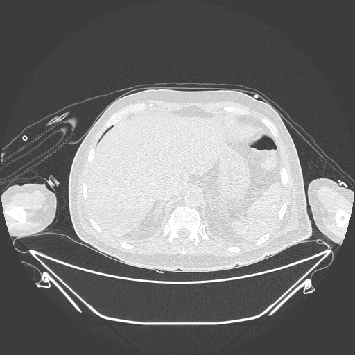 Aortic arch aneurysm (Radiopaedia 84109-99365 Axial lung window 252).jpg