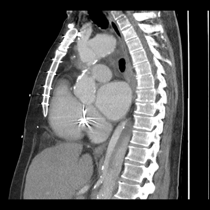 Aortic arch graft infection (FDG PET-CT) (Radiopaedia 71975-82437 C 36).jpg