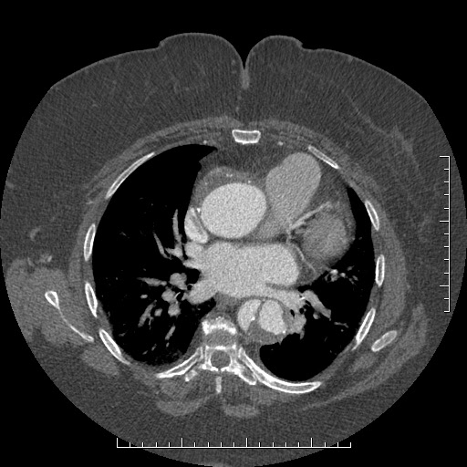 File:Aortic dissection- Stanford A (Radiopaedia 35729-37268 A 48).jpg