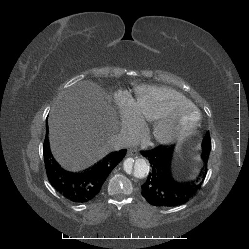 Aortic dissection- Stanford A (Radiopaedia 35729-37268 B 11).jpg