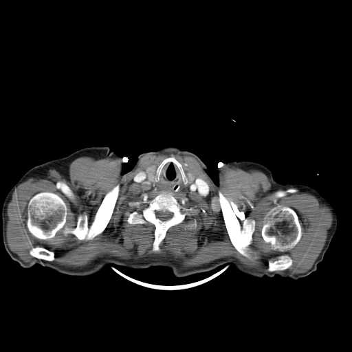 Aortic dissection- Stanford type A (Radiopaedia 22085-22085 A 4).jpg