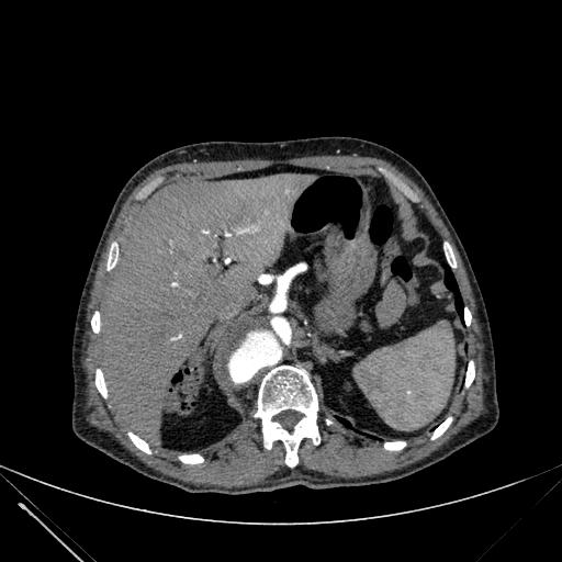 Aortic dissection (Radiopaedia 27466-27665 C+ arterial phase 280).jpg