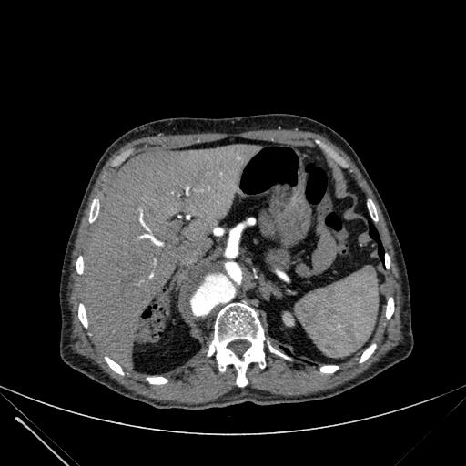 Aortic dissection (Radiopaedia 27466-27665 C+ arterial phase 282).jpg
