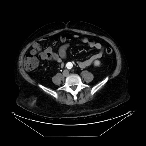 Aortic dissection (Radiopaedia 62562-71000 A 81).jpg