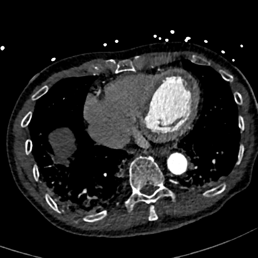File:Aortic dissection - DeBakey type II (Radiopaedia 64302-73082 A 65).png