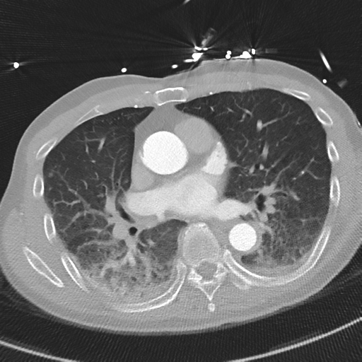 File:Aortic dissection - DeBakey type II (Radiopaedia 64302-73082 Axial lung window 32).png