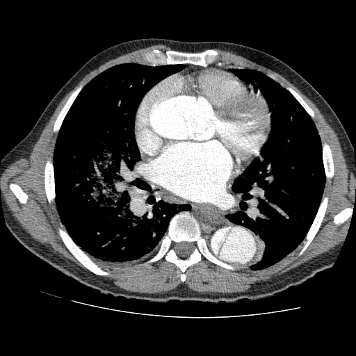 File:Aortic dissection - Stanford A -DeBakey I (Radiopaedia 28339-28587 B 52).jpg