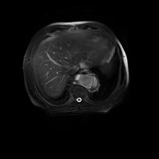 File:Aortic dissection - Stanford A - DeBakey I (Radiopaedia 23469-23551 Axial T2 fat sat 14).jpg