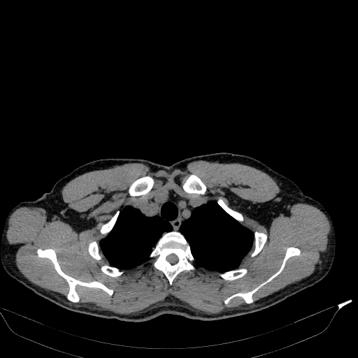 File:Aortic dissection - Stanford type A (Radiopaedia 83418-98500 Axial non-contrast 5).jpg