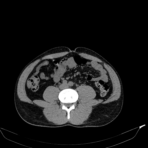 Aortic dissection - Stanford type A (Radiopaedia 83418-98500 Axial non-contrast 65).jpg