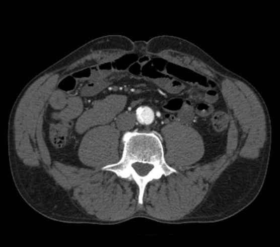 Aortic dissection - Stanford type B (Radiopaedia 73648-84437 A 187).jpg