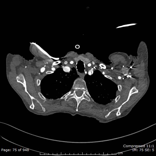 File:Aortic dissection with extension into aortic arch branches (Radiopaedia 64402-73204 B 75).jpg