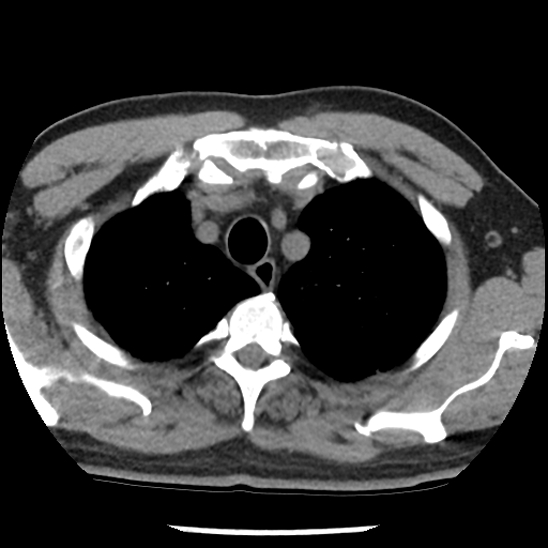 File:Aortic intramural hematoma (type B) (Radiopaedia 79323-92387 Axial non-contrast 7).jpg