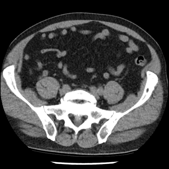 Aortic intramural hematoma (type B) (Radiopaedia 79323-92387 Axial non-contrast 91).jpg