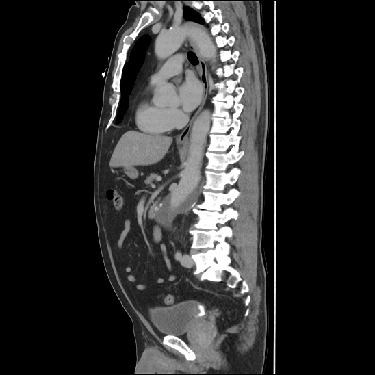 Aortic intramural hematoma (type B) (Radiopaedia 79323-92387 Sagittal C+ delayed 28).jpg