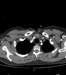 Aortic valve endocarditis (Radiopaedia 87209-103485 C 13).jpg