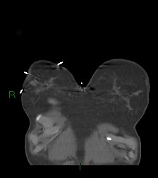 Aortic valve endocarditis (Radiopaedia 87209-103485 D 68).jpg