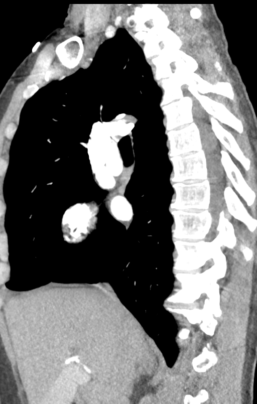 Aortic valve non-coronary cusp thrombus (Radiopaedia 55661-62189 C+ arterial phase 39).png