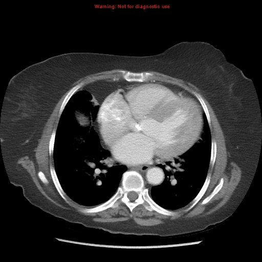 File:Aortic valve stenosis (Radiopaedia 14480-14423 C 12).jpg