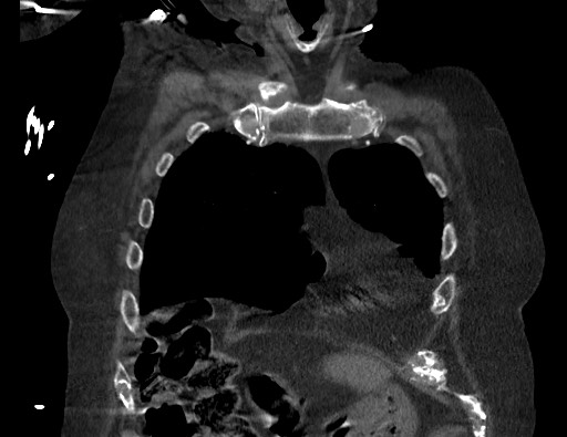 Aortoesophageal fistula with endovascular repair (Radiopaedia 73781-84592 Coronal C+ CTPA 16).jpg