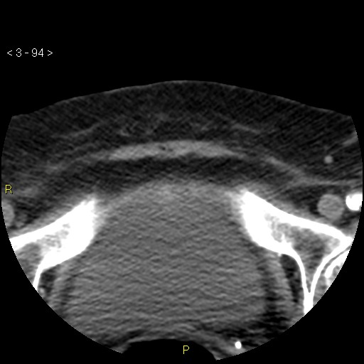Aortoiliac occlusive disease (Radiopaedia 16828-16548 A 94).jpg
