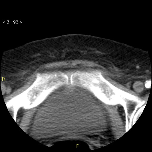 Aortoiliac occlusive disease (Radiopaedia 16828-16548 A 95).jpg