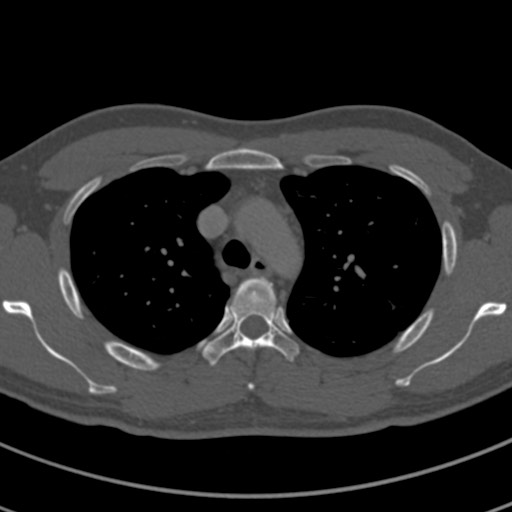 File:Apical lung mass mimic - neurogenic tumor (Radiopaedia 59918-67521 Axial bone window 24).jpg