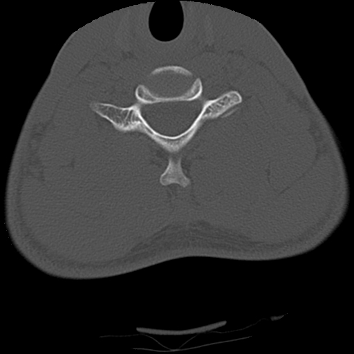 File:Apical pneumothorax on cervical spine CT (Radiopaedia 45343-49368 Axial bone window 65).jpg