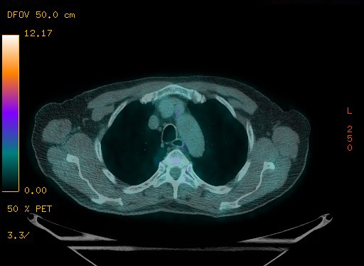 Appendiceal adenocarcinoma complicated by retroperitoneal abscess (Radiopaedia 58007-65041 Axial PET-CT 47).jpg