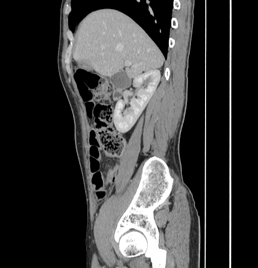 Appendiceal mucinous adenocarcinoma (Radiopaedia 66605-75922 C 18).jpg