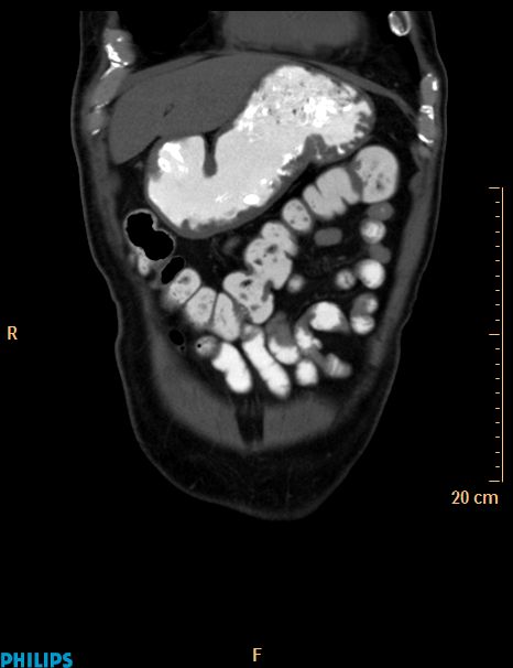 Appendiceal mucocoele (Radiopaedia 29449-29917 E 54).jpg