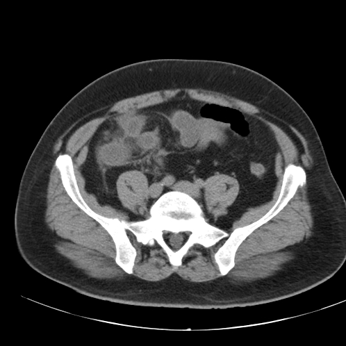 Appendicitis and giant appendicolith (Radiopaedia 80251-93588 Axial non-contrast 41).jpg