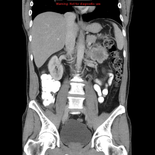 File:Appendicitis and renal cell carcinoma (Radiopaedia 17063-16760 B 17).jpg