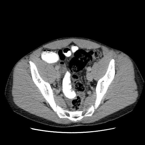 File:Appendicitis complicated by post-operative collection (Radiopaedia 35595-37113 A 63).jpg