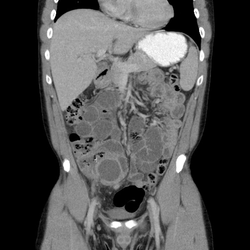 Appendicitis complicated by post-operative collection (Radiopaedia 35595-37114 B 22).jpg
