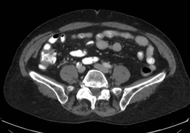 Appendicitis due to chicken fibula (Radiopaedia 74314-85198 A 10).jpg