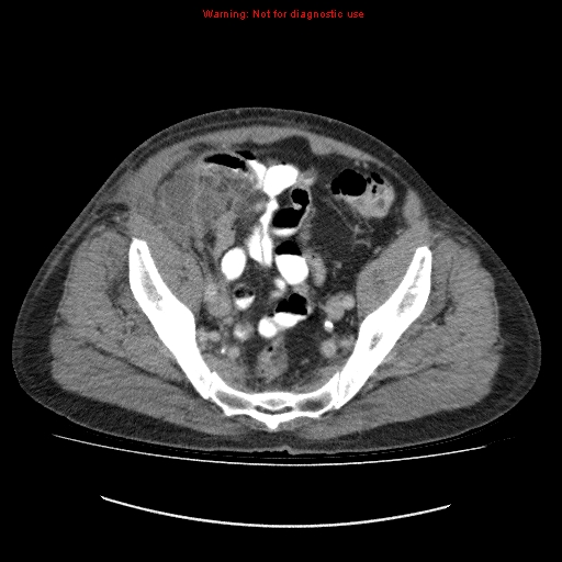 File:Appendicitis mass in inguinal hernia (Radiopaedia 26858-27029 A 16).jpg