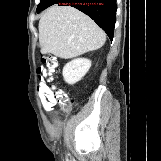 File:Appendicitis mass in inguinal hernia (Radiopaedia 26858-27029 C 11).jpg