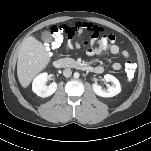 File:Appendicitis with cecal bar sign (Radiopaedia 31878-32830 B 34).jpg