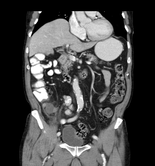 Appendicitis with localized perforation and abscess formation (Radiopaedia 49035-54130 B 22).jpg