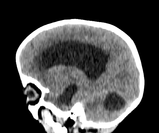 Arachnoid cyst-posterior fossa (Radiopaedia 88661-105370 C 24).jpg