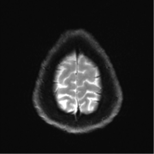 Arachnoid cyst - cerebellopontine angle (Radiopaedia 59689-67083 Axial DWI 33).png