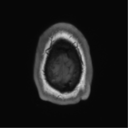 File:Arachnoid cyst with subdural hematoma (Radiopaedia 85892-101743 Axial T1 80).png