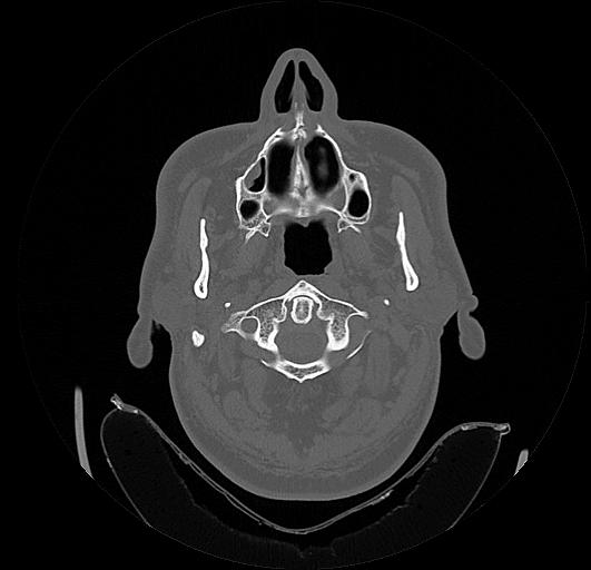Arcuate foramen (Radiopaedia 89833-106944 Axial bone window 23).jpg