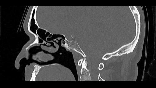 File:Arcuate foramen (Radiopaedia 89833-106944 Sagittal bone window 66).jpg