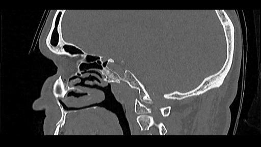 Arcuate foramen (Radiopaedia 89833-106944 Sagittal bone window 78).jpg