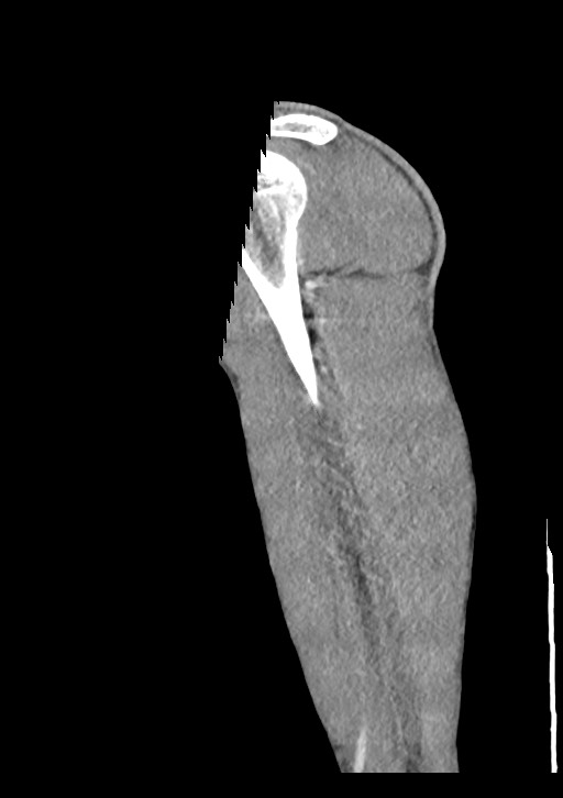 Arrow injury in the neck (Radiopaedia 75268-86390 G 188).jpg